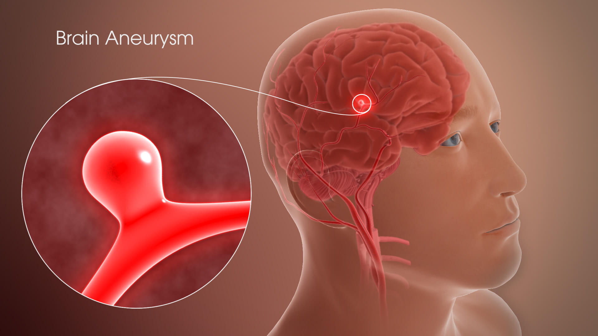 Brain Aneurysm Treatment in Noida