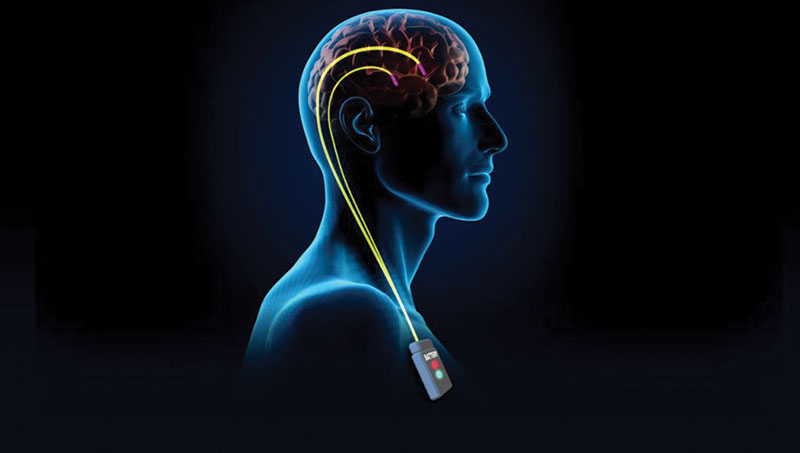 Deep Brain Stimulation Treatment in Noida