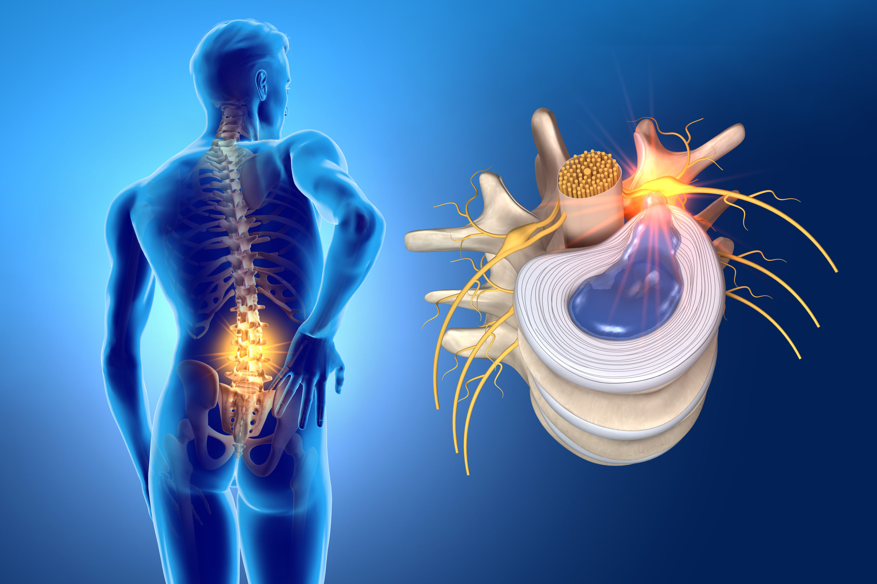 Herniated Disc Treatment in Noida