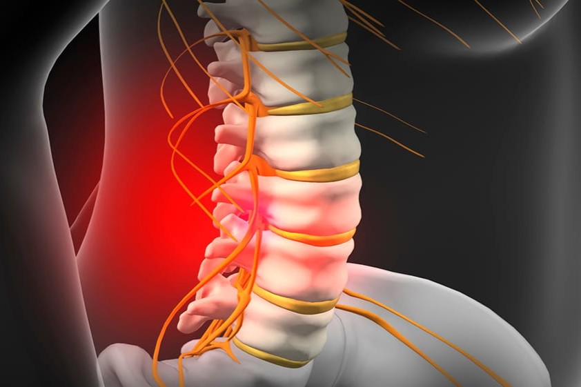 Slip Disc Disease Treatment in Noida