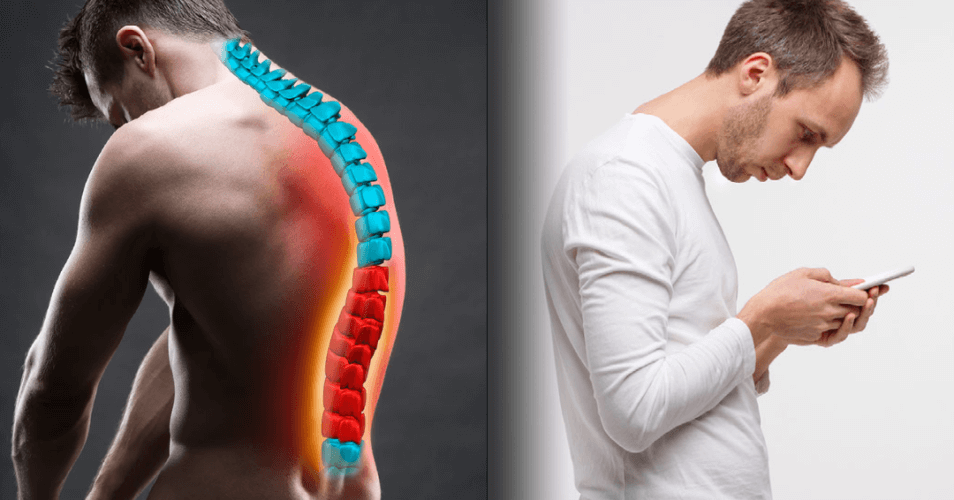Kyphosis Treatment in Noida