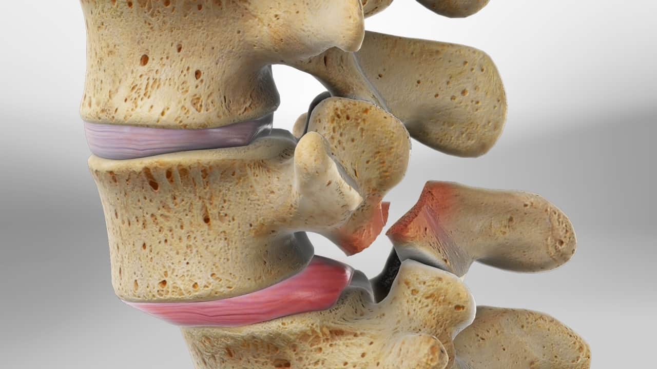 Spondylolysis and Spondylolisthesis Treatment in Noida
