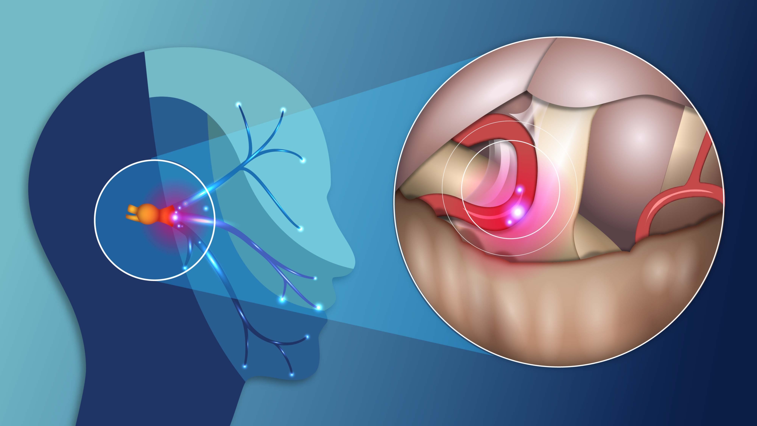 Trigeminal Neuralgia Treatment in Noida